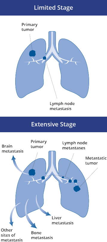 What is Small Cell Lung Cancer (SCLC)? | TECENTRIQ® (atezolizumab)
